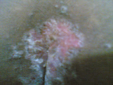Eczema - Befroe Treatment