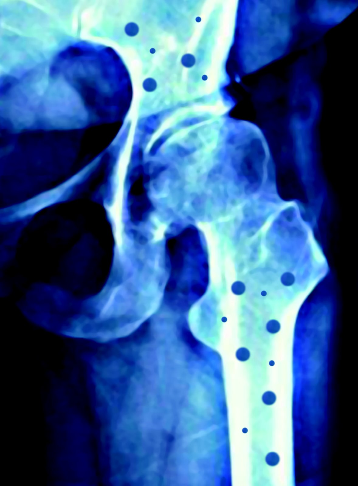[osteoporosis.jpg]