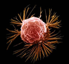 [breast-cell-carcinoma.jpg]