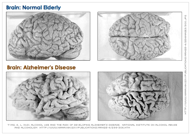 Beta Amyloid plaque on the alzheimer"s brain