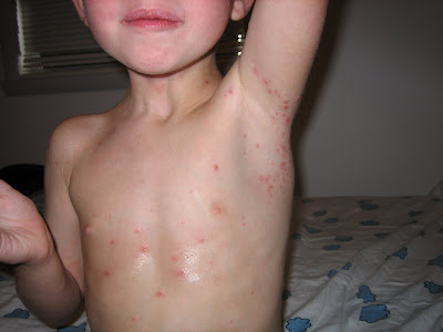 Children and chickenpox stages symptoms can spread First shingles stage