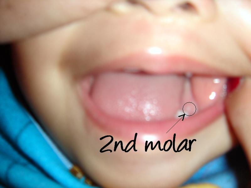 [2nd+molar+II.JPG]
