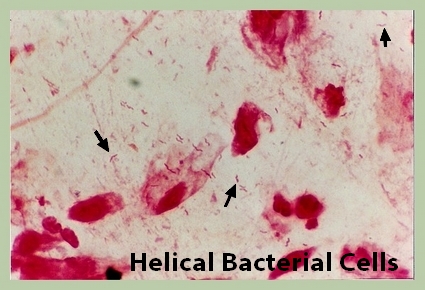 [Helicobacter+Pylori+Blog.jpg]