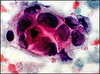 [_44186045_breast_cancer_cells203.jpg]