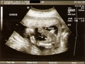 ultrasound gender girl
