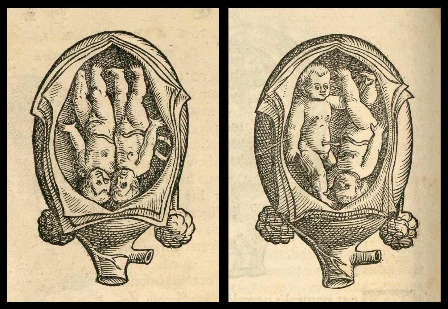twin fetus positions in uterus (Rueff, 1554)