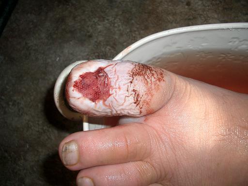 [Toe+After.JPG]