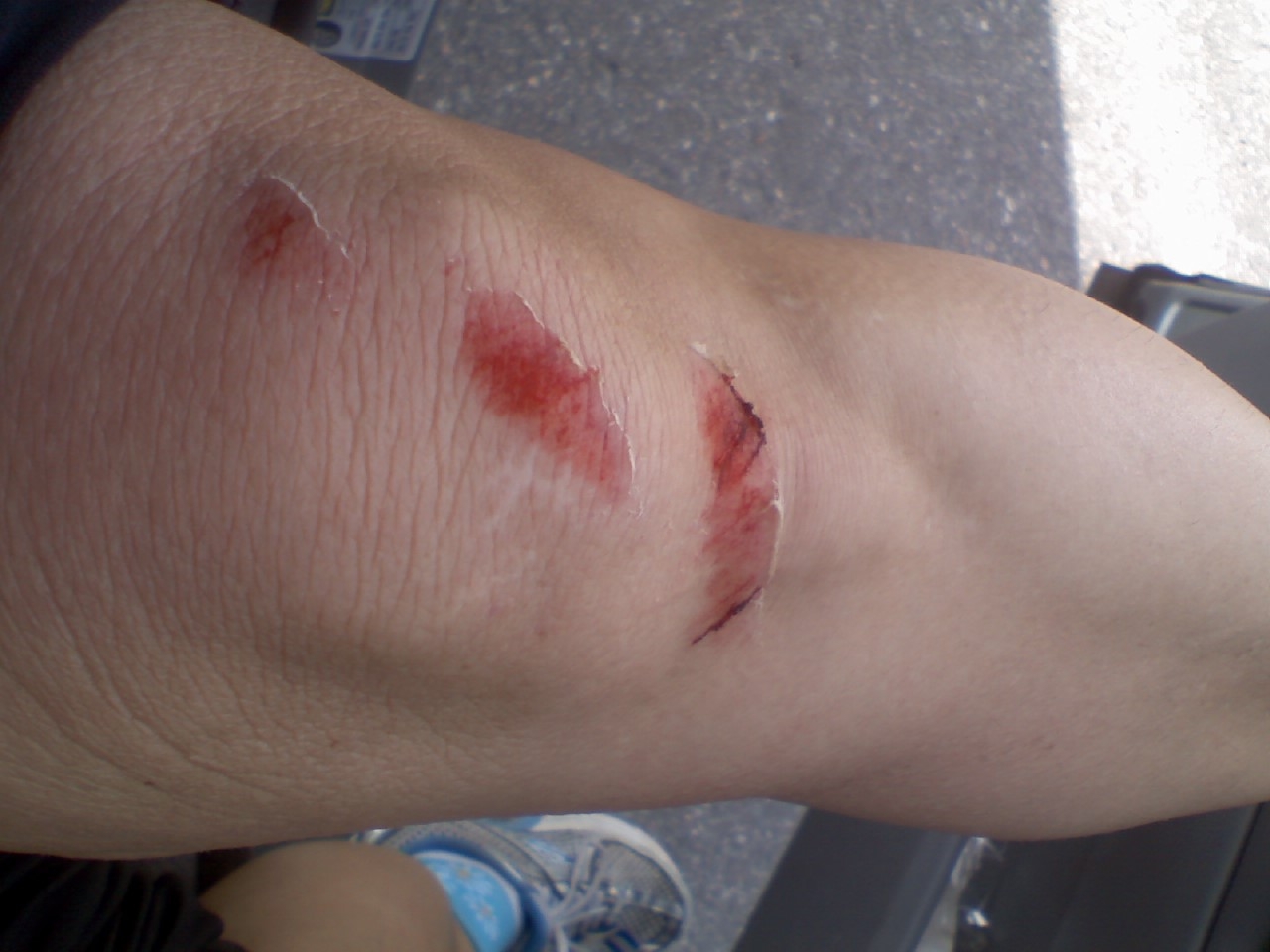 [scraped+knee.JPG]