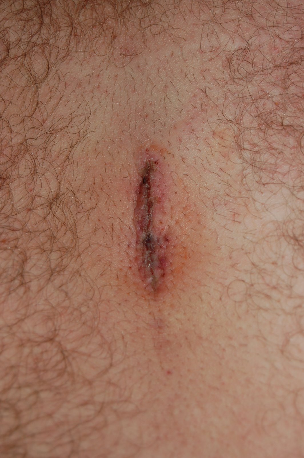 Fresh scar after a microdiscotomy of the L4-5.  They glued him shut!
