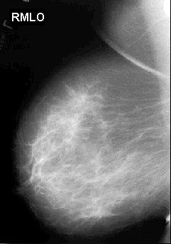 [R+MLO+Mammogram+Normal.gif]