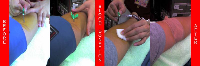 [800px-Blood_donation_needle.jpg]