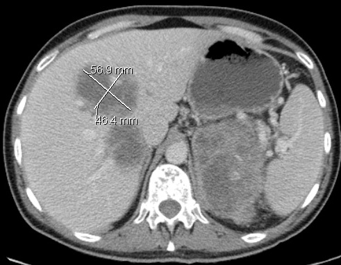 CT Scan Liver post chemo2 for comparison
