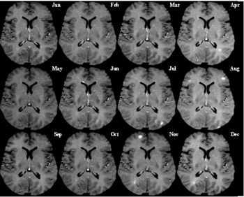 [350px-MRI_Monthly_multiple_sclerosis_MRI.gif]