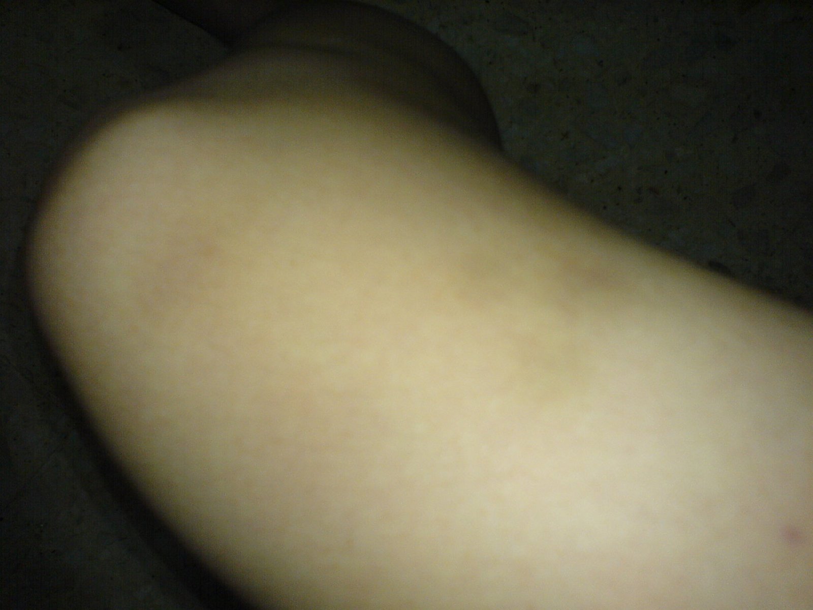 [bruise+2.JPG]