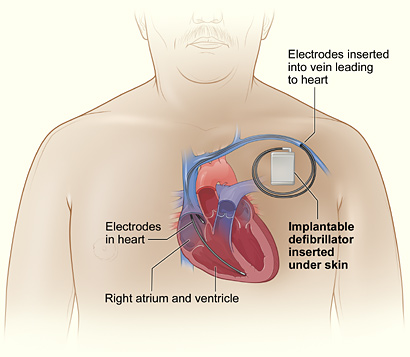 [Implantable+cardioverter+defibrillator.jpg]